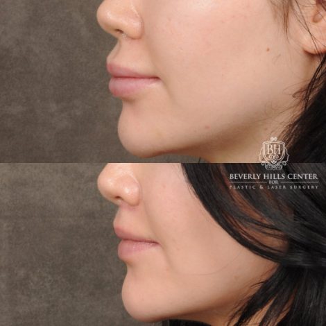Beverly Hills Center Female Patient Before and After Lip Lift