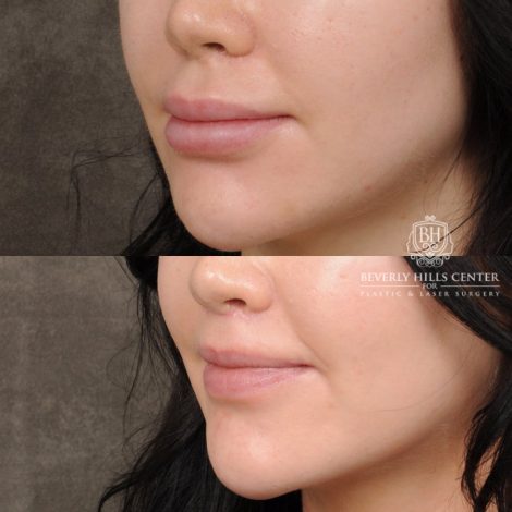 Beverly Hills Center Female Patient Before and After Lip Lift