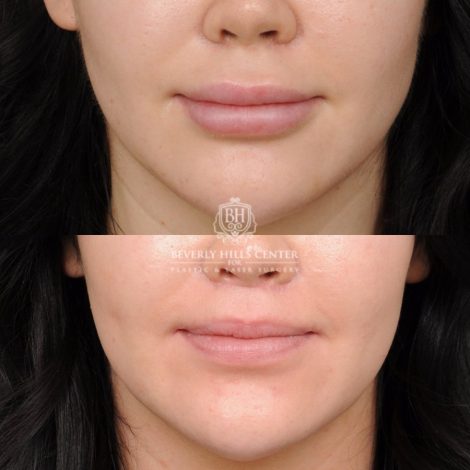 Beverly Hills Center Female Patient Before and After Lip Lift