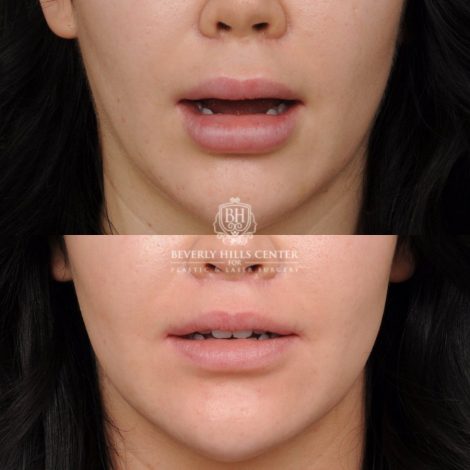 Beverly Hills Center Female Patient Before and After Lip Lift