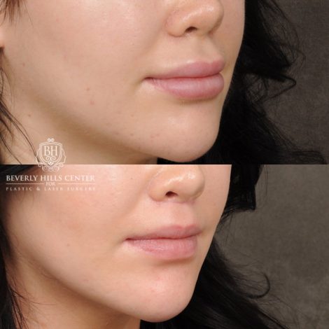 Beverly Hills Center Female Patient Before and After Lip Lift