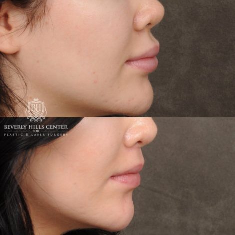 Beverly Hills Center Female Patient Before and After Lip Lift