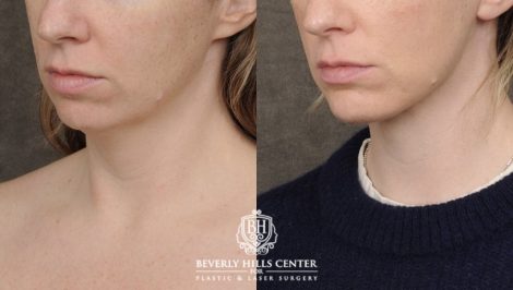 Beverly Hills Center Female Patient Before and After Weekend Neck Lift