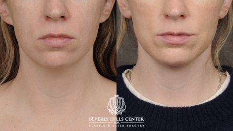 Beverly Hills Center Female Patient Before and After Weekend Neck Lift