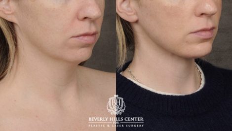 Beverly Hills Center Female Patient Before and After Weekend Neck Lift