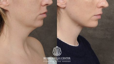 Beverly Hills Center Female Patient Before and After Weekend Neck Lift