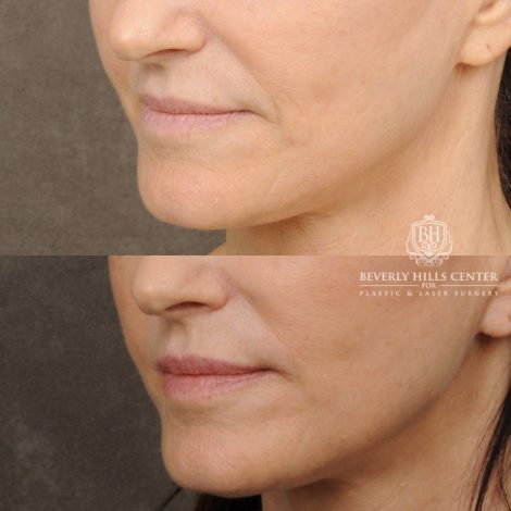 Beverly Hills Center Female Patient Before and After Profound, Nanofat PRP, CUPID LIFT® with corners
