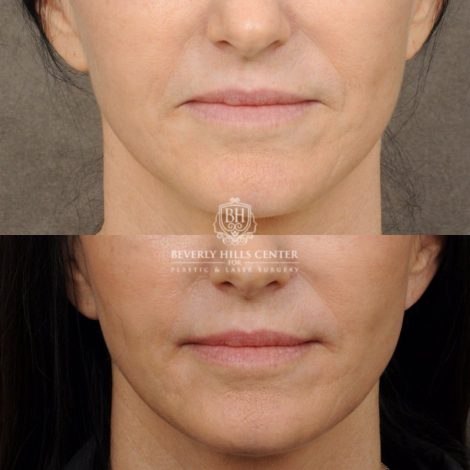 Beverly Hills Center Female Patient Before and After Profound, Nanofat PRP, CUPID LIFT® with corners