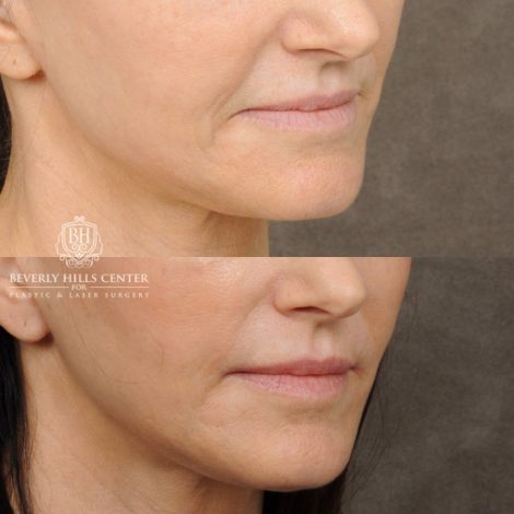 Beverly Hills Center Female Patient Before and After Profound, Nanofat PRP, CUPID LIFT® with corners