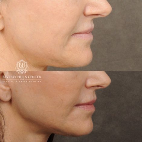 Beverly Hills Center Female Patient Before and After Profound, Nanofat PRP, CUPID LIFT® with corners