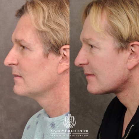 Beverly Hills Center Male Patient Before and After AuraLyft, Brow Lift, CO2