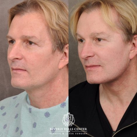 Beverly Hills Center Male Patient Before and After AuraLyft, Brow Lift, CO2