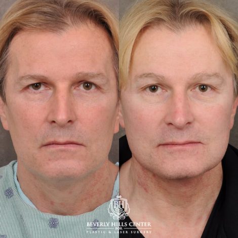 Beverly Hills Center Male Patient Before and After AuraLyft, Brow Lift, CO2