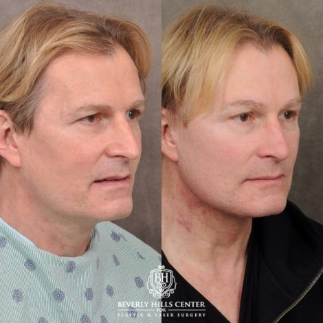 Beverly Hills Center Male Patient Before and After AuraLyft, Brow Lift, CO2