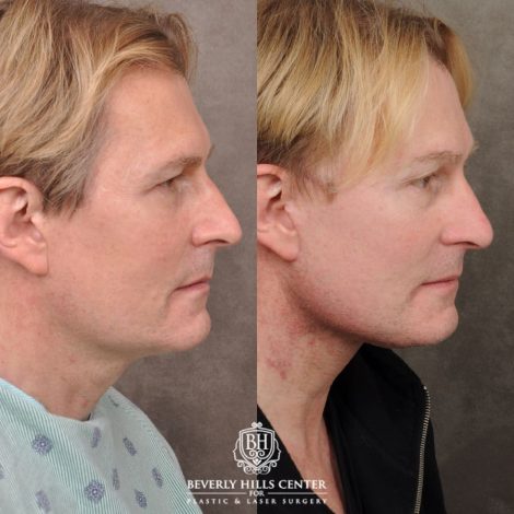 Beverly Hills Center Male Patient Before and After AuraLyft, Brow Lift, CO2
