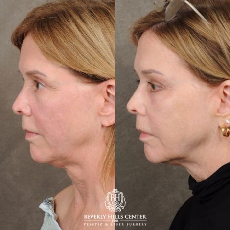 Beverly Hills Center Female Patient Before and After Upper Blepharoplasty, Profound RF, Osteoma Excision, Nano Fat with PRP