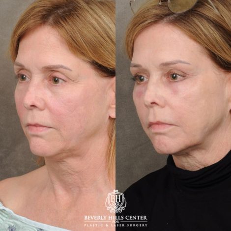 Beverly Hills Center Female Patient Before and After Upper Blepharoplasty, Profound RF, Osteoma Excision, Nano Fat with PRP