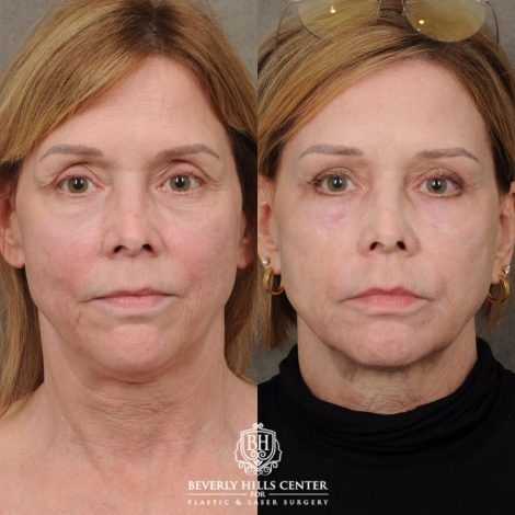 Beverly Hills Center Female Patient Before and After Upper Blepharoplasty, Profound RF, Osteoma Excision, Nano Fat with PRP