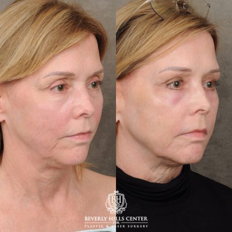 Beverly Hills Center Female Patient Before and After Upper Blepharoplasty, Profound RF, Osteoma Excision, Nano Fat with PRP