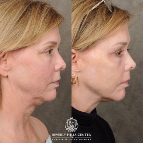 Beverly Hills Center Female Patient Before and After Upper Blepharoplasty, Profound RF, Osteoma Excision, Nano Fat with PRP
