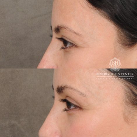 Beverly Hills Center Female Patient Before and After Brow Lift & Upper Blepharoplasty