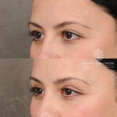 Beverly Hills Center Female Patient Before and After Brow Lift & Upper Blepharoplasty