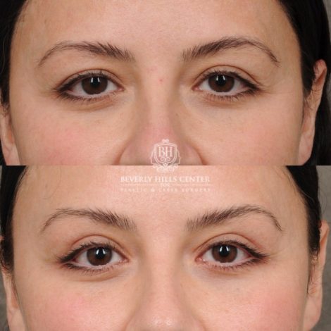 Beverly Hills Center Female Patient Before and After Brow Lift & Upper Blepharoplasty