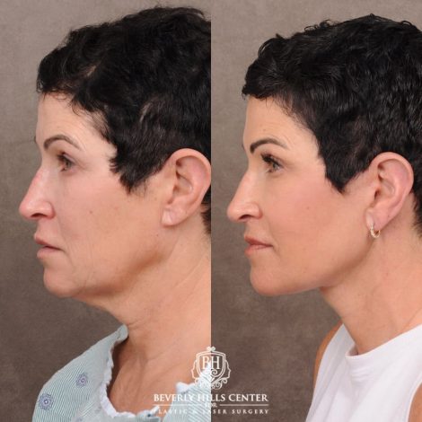 Beverly Hills Center Female Patient Before and After Comprehensive AuraLyft
