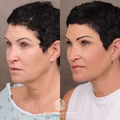 Beverly Hills Center Female Patient Before and After Comprehensive AuraLyft