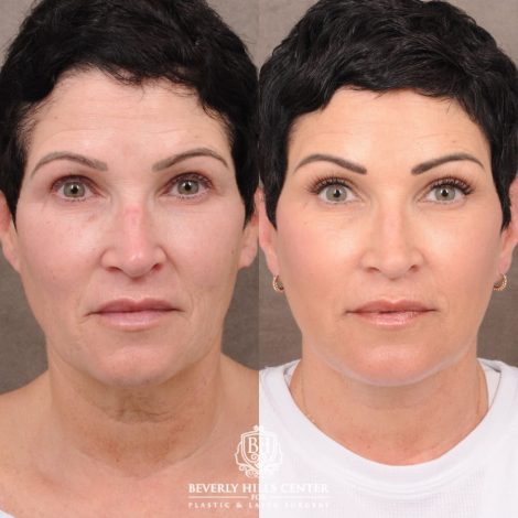 Beverly Hills Center Female Patient Before and After Comprehensive AuraLyft