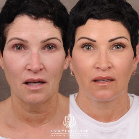 Beverly Hills Center Female Patient Before and After Comprehensive AuraLyft