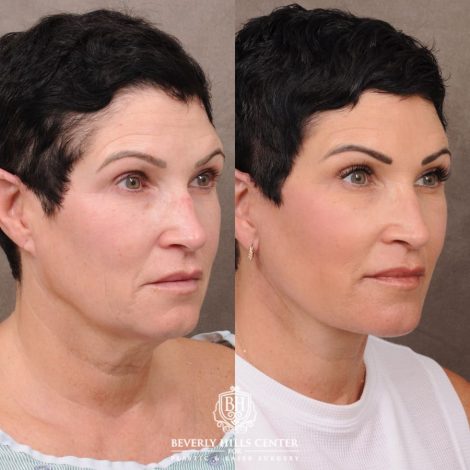 Beverly Hills Center Female Patient Before and After Comprehensive AuraLyft