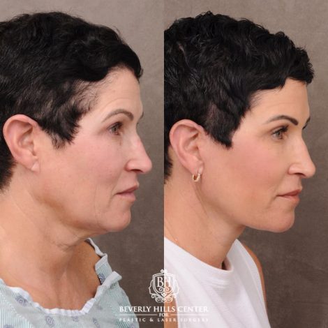 Beverly Hills Center Female Patient Before and After Comprehensive AuraLyft
