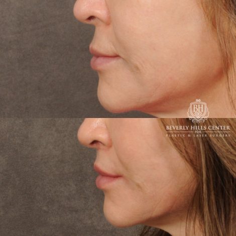 Beverly Hills Center Male Patient Before and After CUPID LIFT® Lip Lift