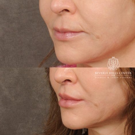 Beverly Hills Center Male Patient Before and After CUPID LIFT® Lip Lift