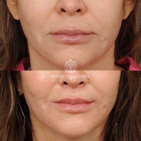 Beverly Hills Center Male Patient Before and After CUPID LIFT® Lip Lift