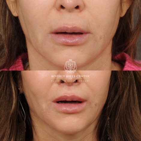 Beverly Hills Center Male Patient Before and After CUPID LIFT® Lip Lift