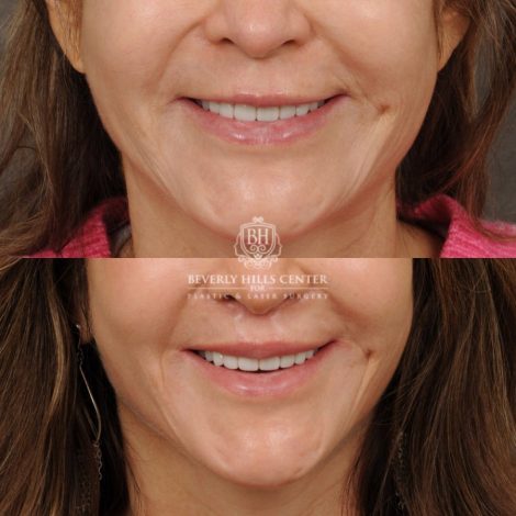Beverly Hills Center Male Patient Before and After CUPID LIFT® Lip Lift