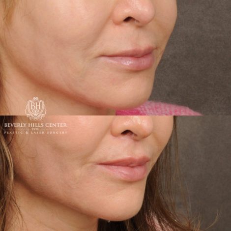 Beverly Hills Center Male Patient Before and After CUPID LIFT® Lip Lift
