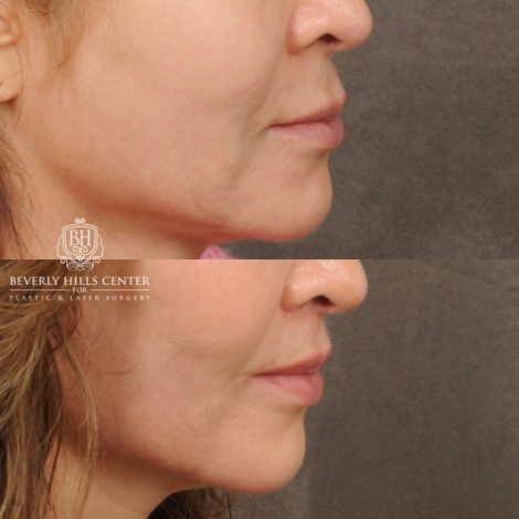 Beverly Hills Center Male Patient Before and After CUPID LIFT® Lip Lift