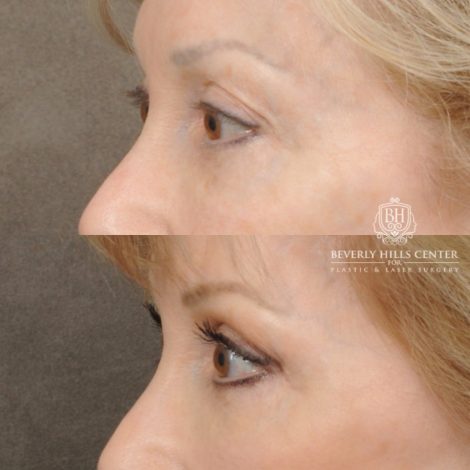 Beverly Hills Center Female Patient Before and After Auralyft, Upper and Lower Bleph