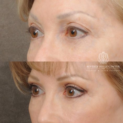 Beverly Hills Center Female Patient Before and After Auralyft, Upper and Lower Bleph
