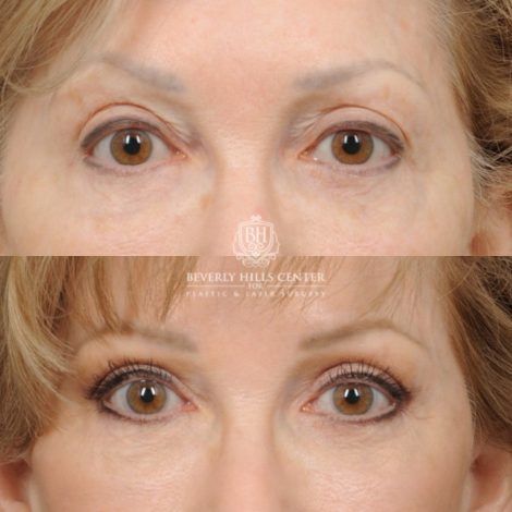 Beverly Hills Center Female Patient Before and After Auralyft, Upper and Lower Bleph