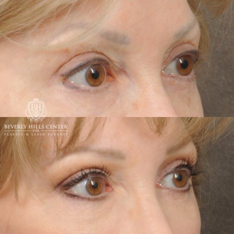 Beverly Hills Center Female Patient Before and After Auralyft, Upper and Lower Bleph