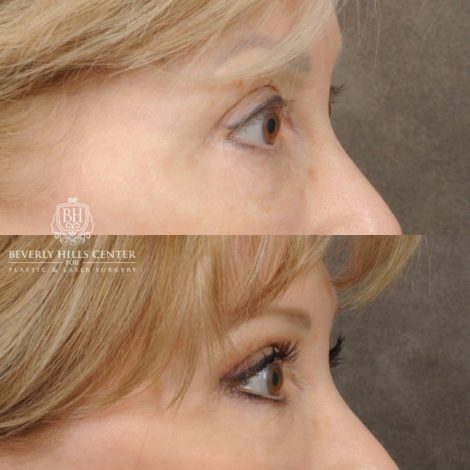 Beverly Hills Center Female Patient Before and After Auralyft, Upper and Lower Bleph