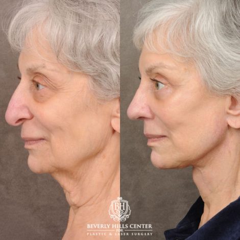 Beverly Hills Center Female Patient Before and After AuraLyft, Brow Lift, Upper & Lower Blepharoplasty, CUPID LIFT® Lip Lift, Rhinoplasty