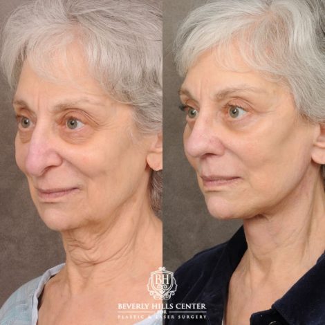 Beverly Hills Center Female Patient Before and After AuraLyft, Brow Lift, Upper & Lower Blepharoplasty, CUPID LIFT® Lip Lift, Rhinoplasty