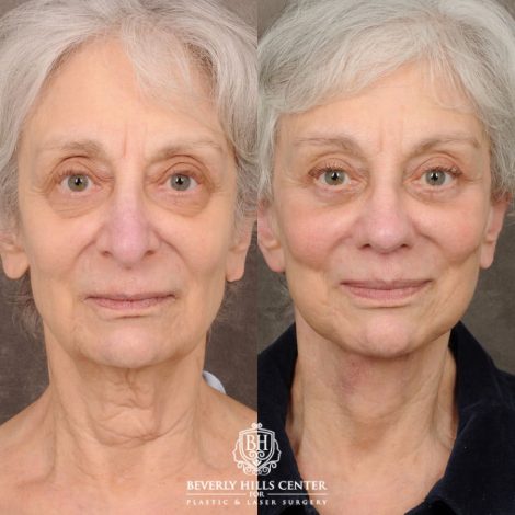 Beverly Hills Center Female Patient Before and After AuraLyft, Brow Lift, Upper & Lower Blepharoplasty, CUPID LIFT® Lip Lift, Rhinoplasty