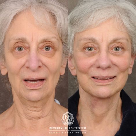 Beverly Hills Center Female Patient Before and After AuraLyft, Brow Lift, Upper & Lower Blepharoplasty, CUPID LIFT® Lip Lift, Rhinoplasty