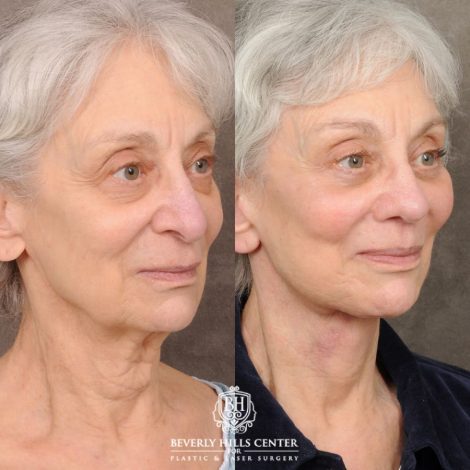 Beverly Hills Center Female Patient Before and After AuraLyft, Brow Lift, Upper & Lower Blepharoplasty, CUPID LIFT® Lip Lift, Rhinoplasty